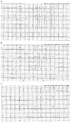 Case Report: Coexistent Wolff-Parkinson-White Syndrome and Brugada Phenocopy in a Patient With Pneumonia and Myocarditis